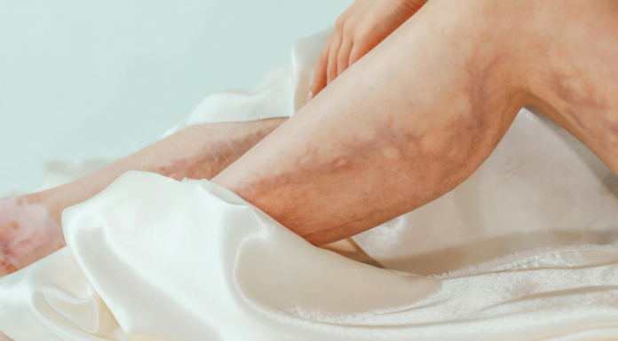 ¿Qué son las várices? | Síntomas, tratamientos y mitos