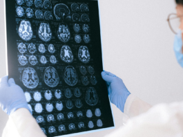 Enfermedades sistema nervioso central | Afecciones y prevención Enfermedades sistema nervioso central