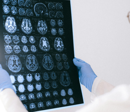 Enfermedades sistema nervioso central | Afecciones y prevención Enfermedades sistema nervioso central